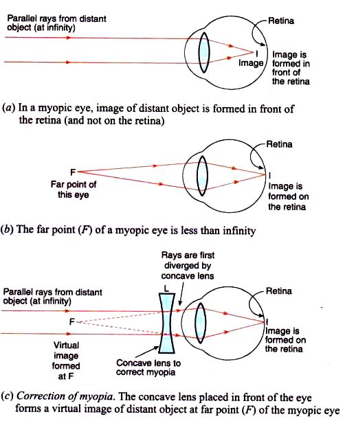 Lakhmir Singh Physics Class 10 Solutions Correction of myopia Q24